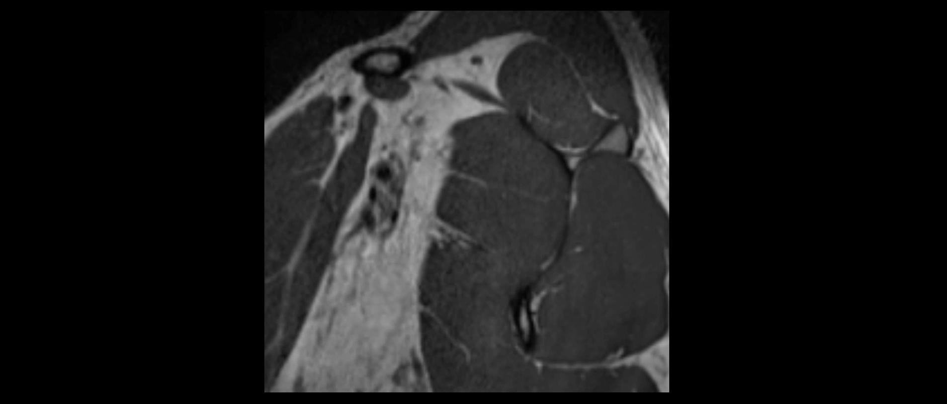 shoulder ligaments sagittal  cross sectional anatomy 3T MRI AI enhanced radiology image -img-00001-00001.webp